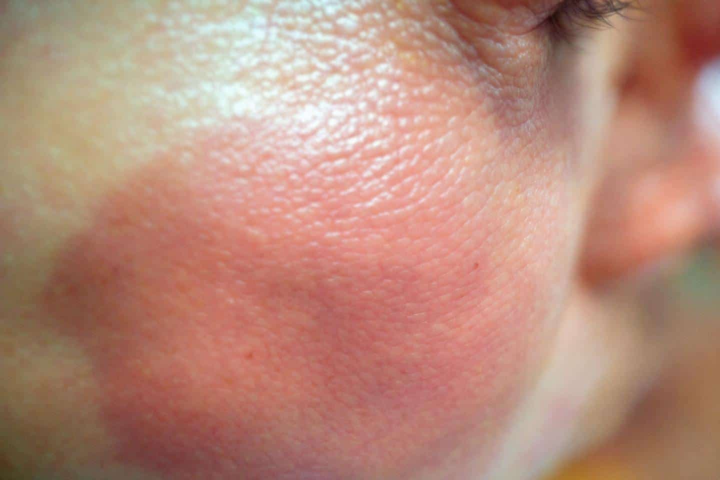 Chirurgie réparatrice après perte de poids : retrouver son corps et son ventre plat